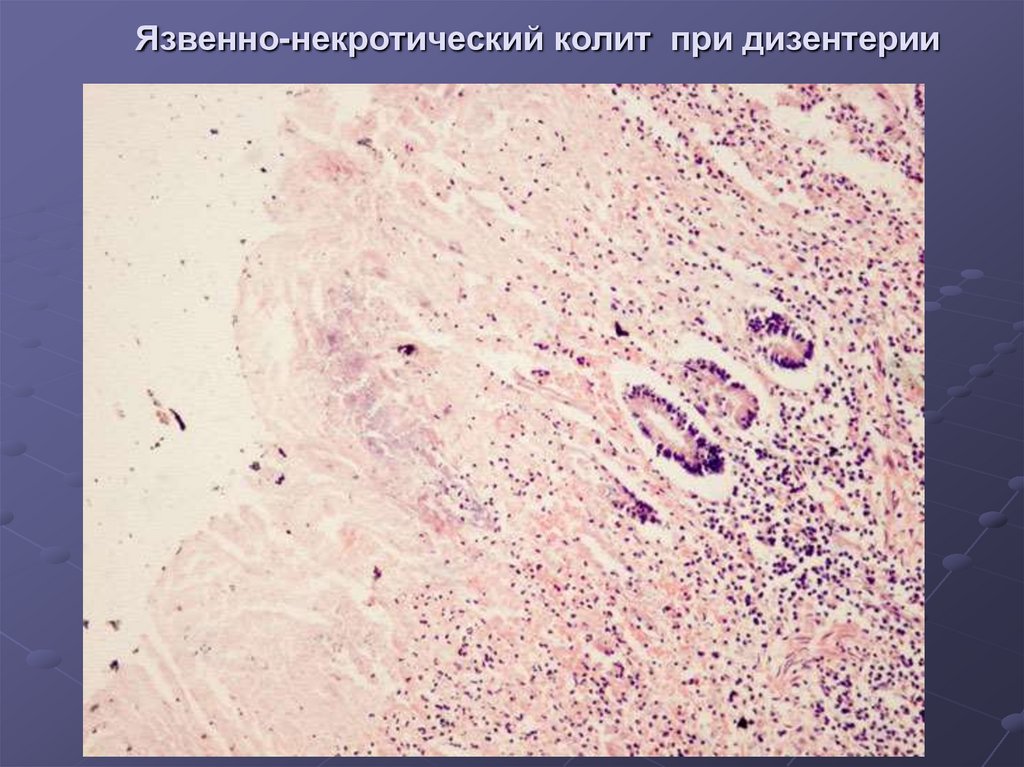 Дизентерия презентация патологическая анатомия