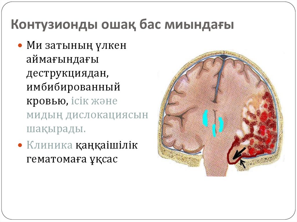 Белые очаги в головном мозге. Контузионный очаг в головном мозге. Контузионный очаг на кт. Гематомы головного мозга классификация.