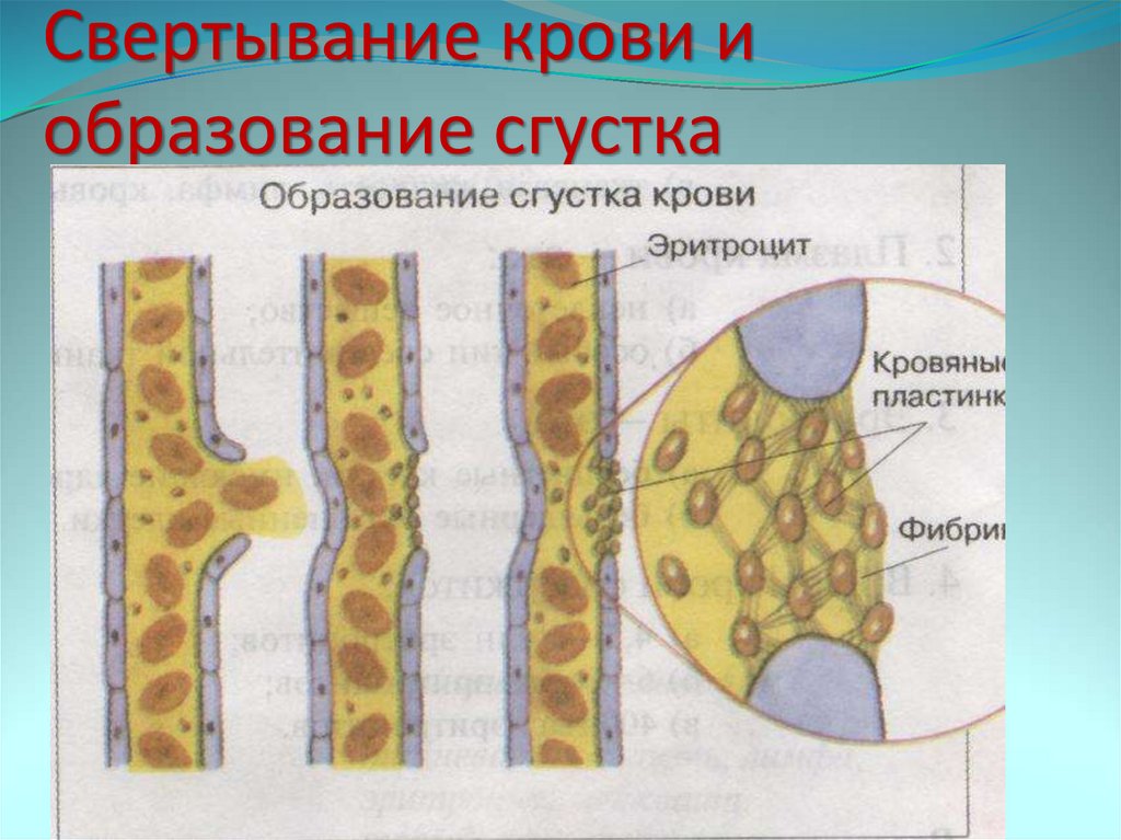 Схема образования сгустка в просвете сосуда