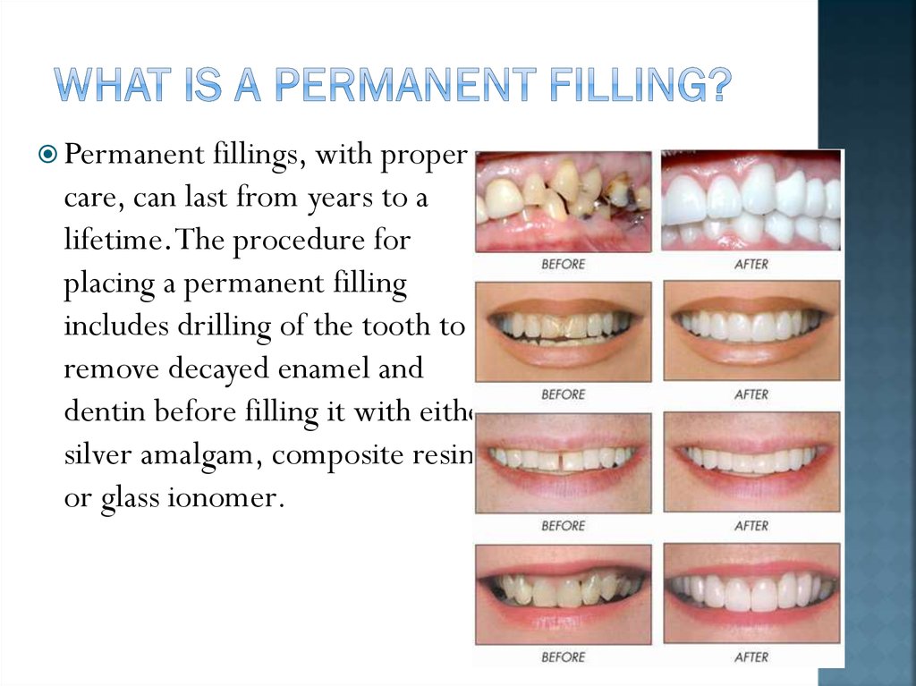 permanent tooth filling