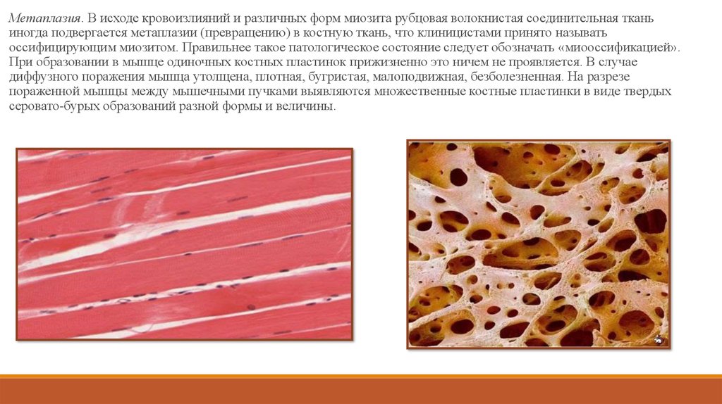 Заболевания мышечной ткани. Метаплазия мышечной ткани. Патоморфология мышечной ткани. Рубцовая соединительная ткань. Метаплазия соединительной ткани в костную.