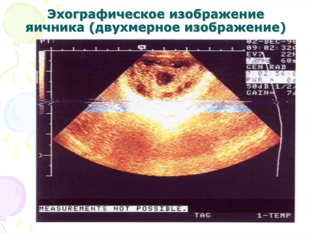 Аномалии развития яичников презентация