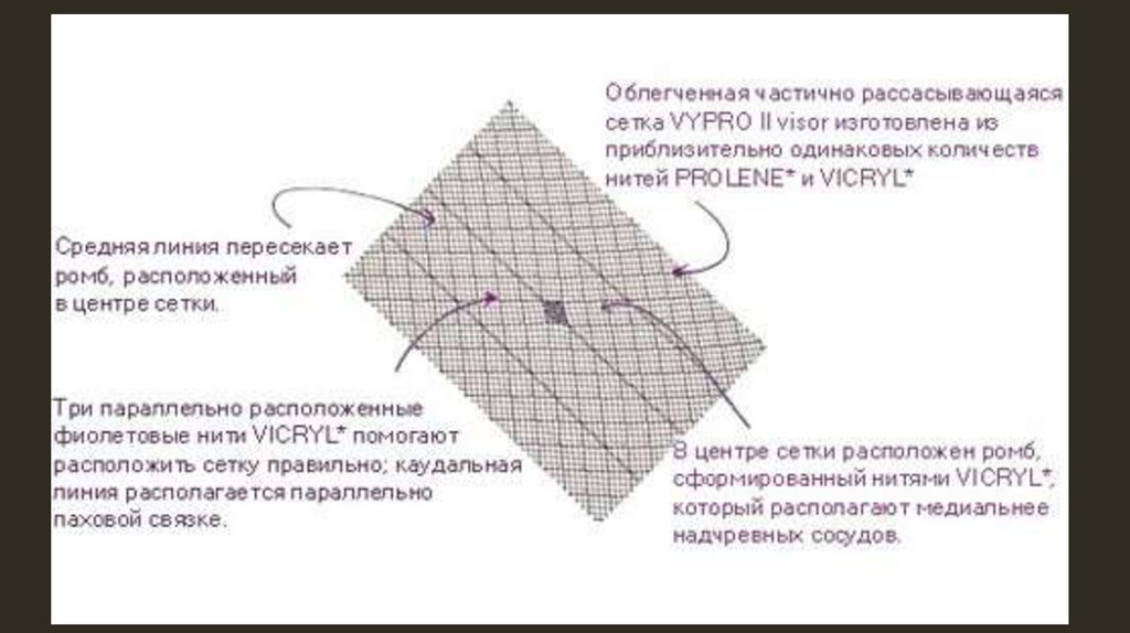 Сетка состоит из. Сетка на брюшную стенку. Сетка для грыжи белой линии. Сетка двухслойная для грыж. Операция на паховую грыжу сеткой.