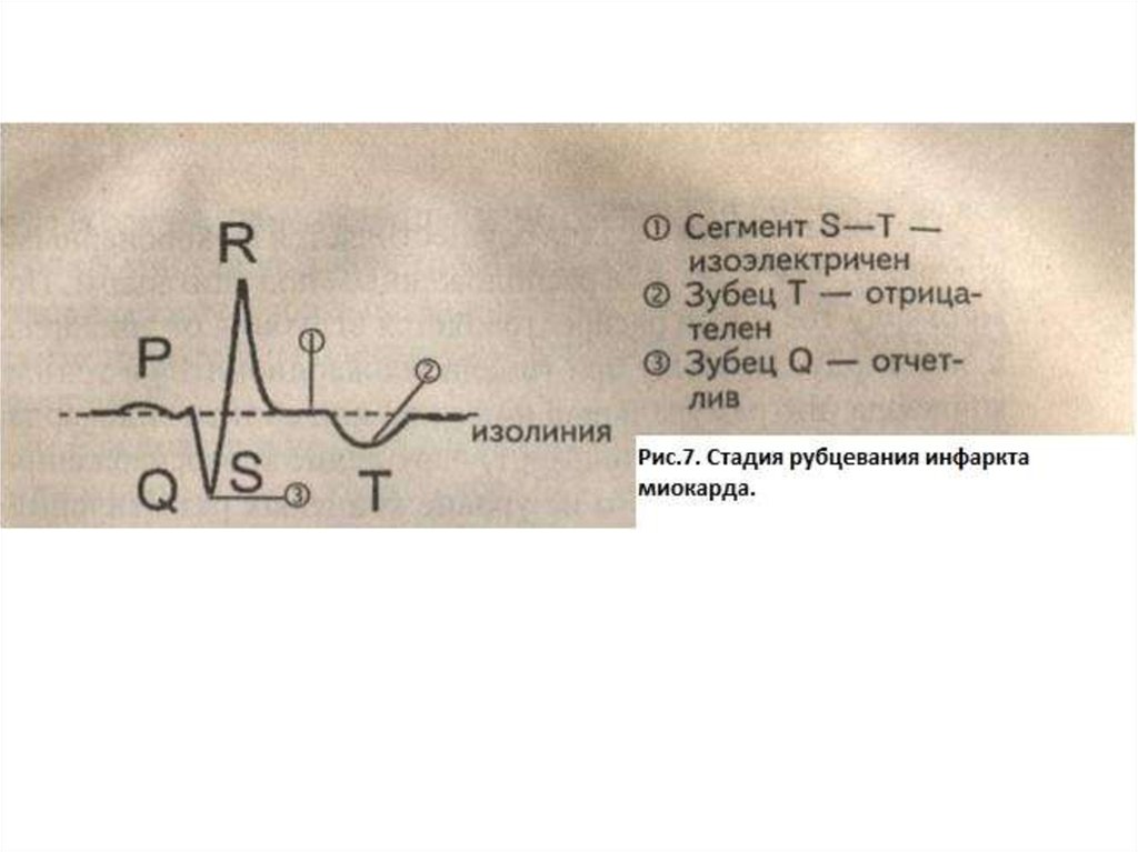 Признаки инфаркта миокарда тест с ответами