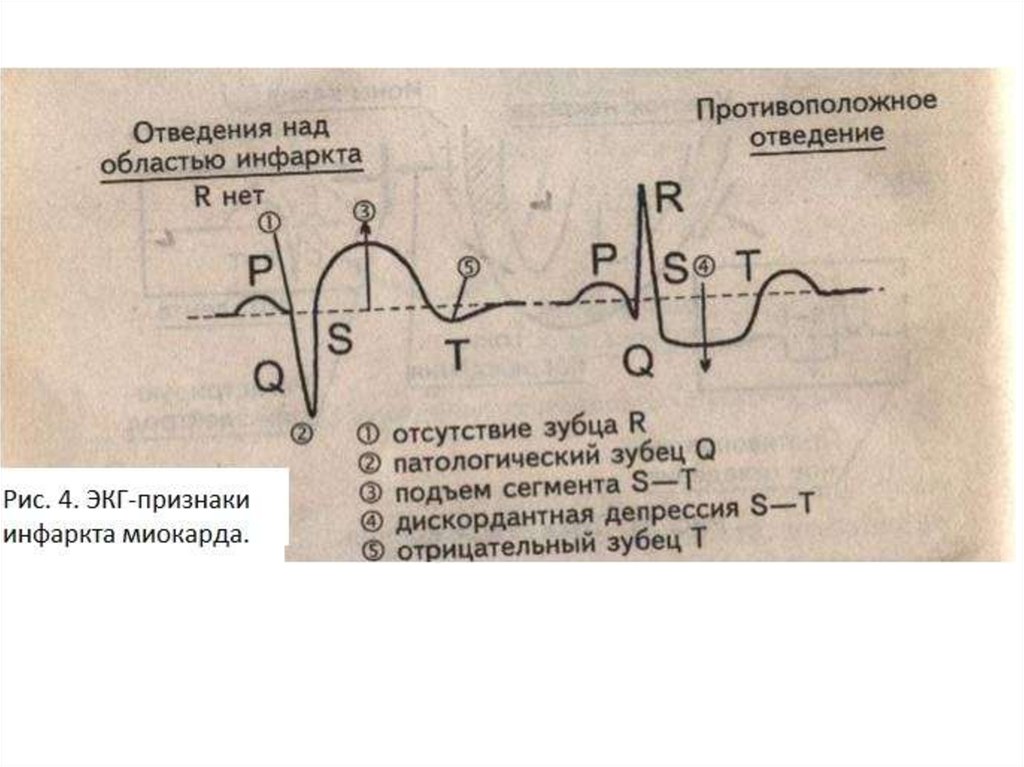 Для патологического зубца q характерно