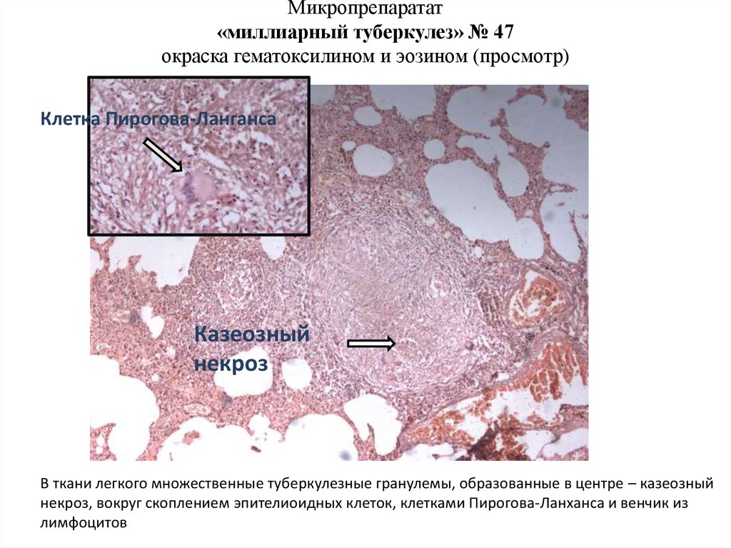 Пневмония микропрепарат описание. Казеозный некроз гистология. Милиарный туберкулез легких (окраска гематоксилином-эозином).. Туберкулез казеозный некроз лимфоузла. Очаг казеозного некроза в легком микропрепарат.