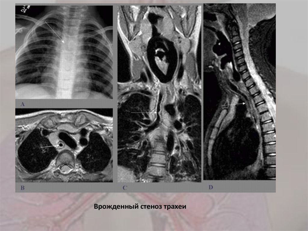 Стеноз у ребенка. Стеноз трахеи трахеомаляция. Стеноз трахеи идиопатический. Врожденные стеноз бронхов.