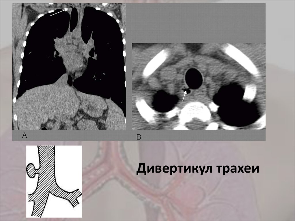 Пороки Развития Трахеи