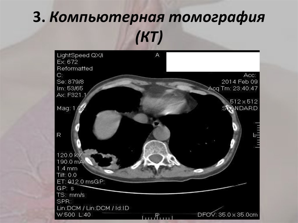 3. Компьютерная томография (КТ)