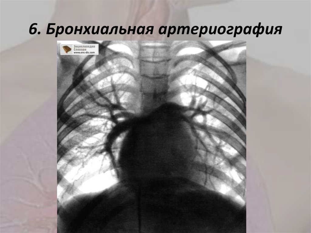 6. Бронхиальная артериография