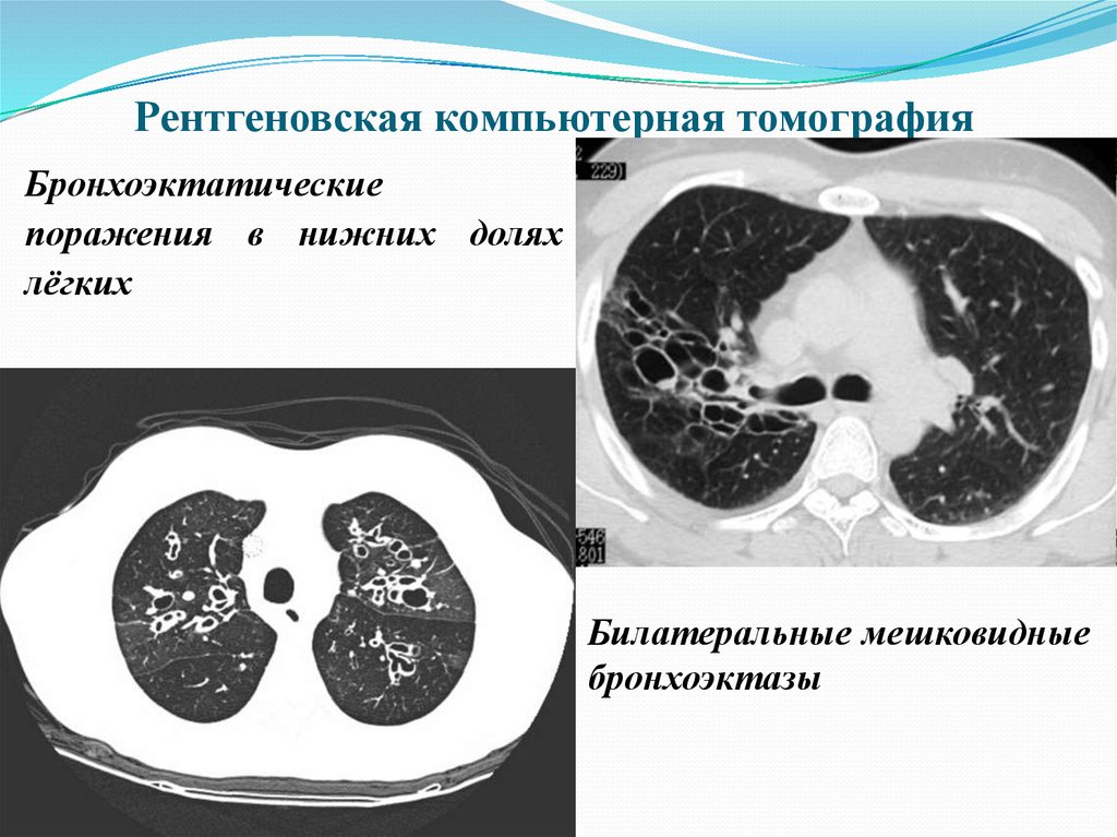 Кт картина бронхоэктазов