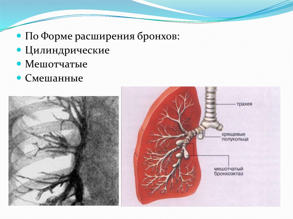 Расширение бронхов. Бронхоэктатическая болезнь мешотчатая. Формы расширения бронхов. Цилиндрическое расширение бронхов.