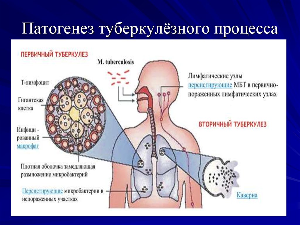 Нервный туберкулез. Этиология туберкулеза. Патогенез туберкулеза. Причины первичного туберкулеза. Туберкулез кожи патогенез.