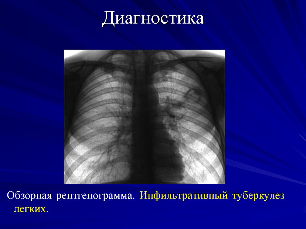 Перисциссурит рентген картина