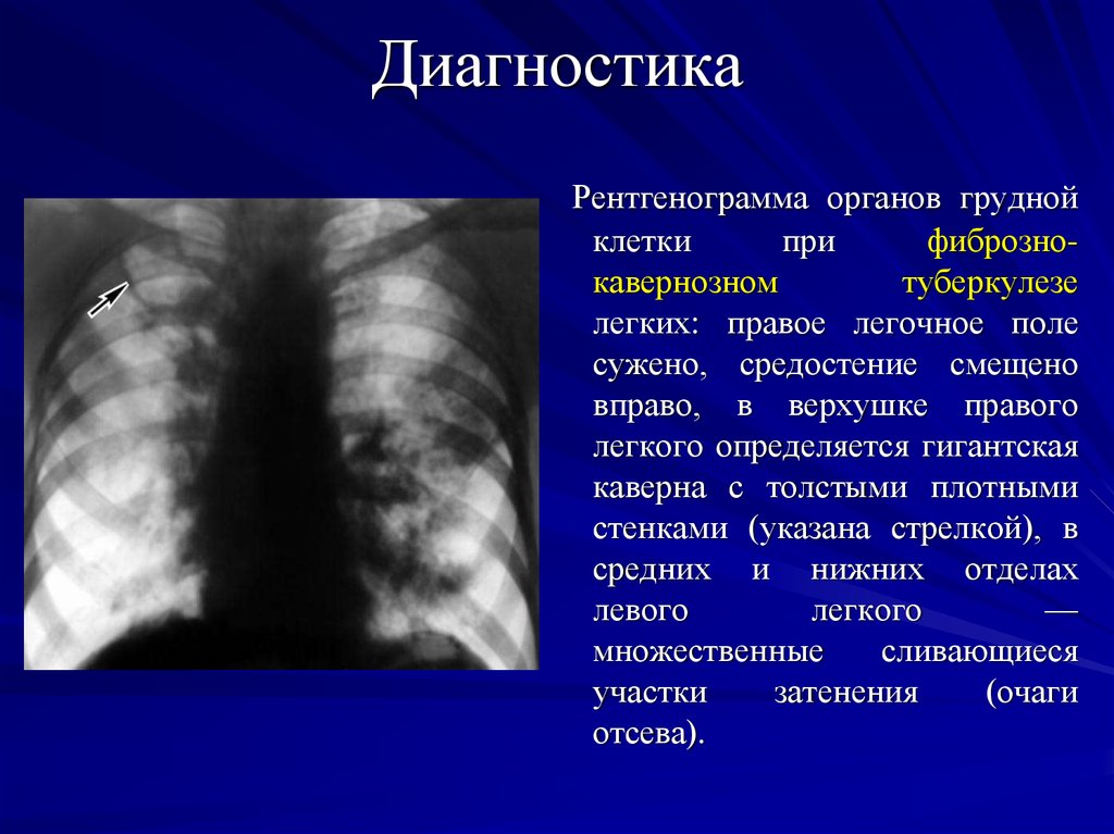 Клинический случай туберкулез. Туберкулез каверны рентгенограмма. Фиброзно-кавернозный туберкулез рентген. Рентгенограмма грудной клетки при туберкулезе. Кавернозный туберкулез легких презентация.
