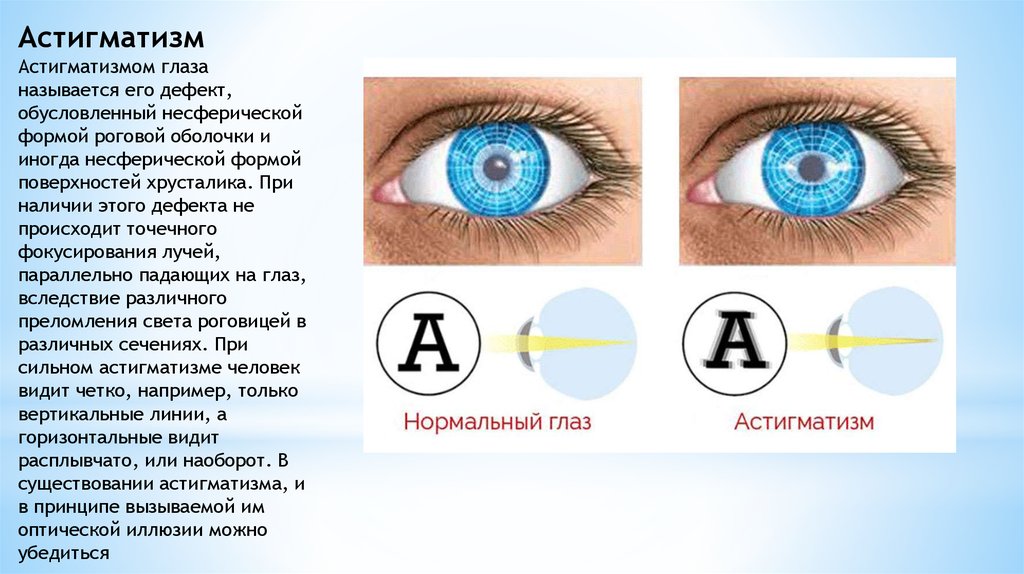 Зрение двумя глазами называют. Расплывается в глазах. Как называется глаз. Глаз и его дефекты. Несферическая форма роговицы глаза.