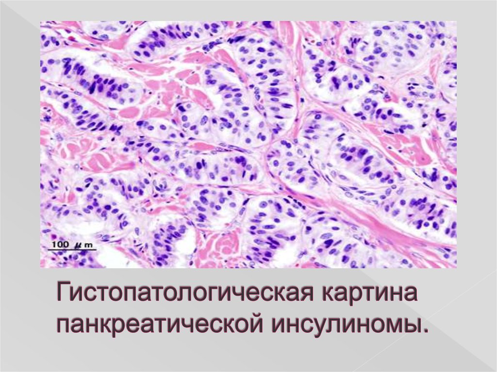 Гистопатологическая картина панкреатической инсулиномы.