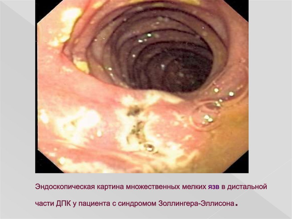 Эндоскопическая картина множественных мелких язв в дистальной части ДПК у пациента с синдромом Золлингера-Эллисона.