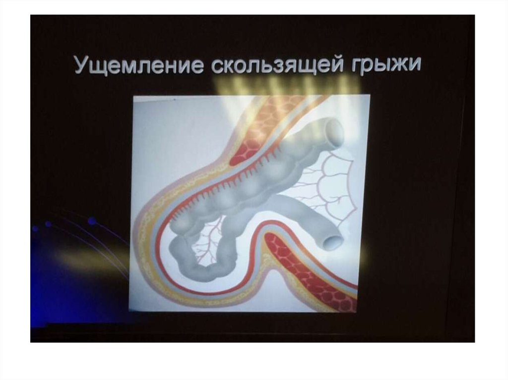 Грыжи живота - online presentation