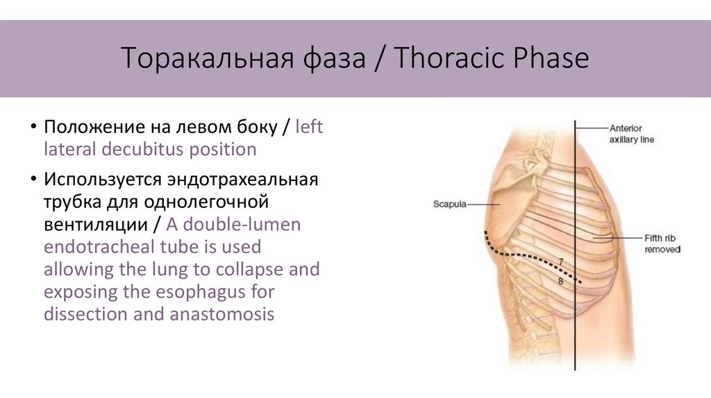 Операция льюиса схема