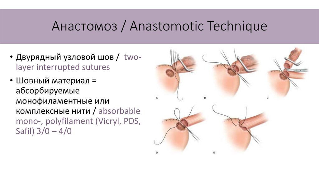 Операция льюиса схема