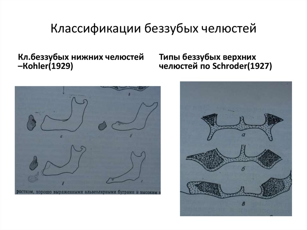 Беззубая челюсть по шредеру. Классификация беззубых нижних челюстей по Келлеру. Классификация беззубых челюстей по и.м. Оксману. Классификации Шредера для беззубой верхней челюсти. Классификация по Келлеру на нижней челюсти.