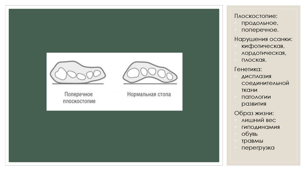 Продольное и поперечное плоскостопие