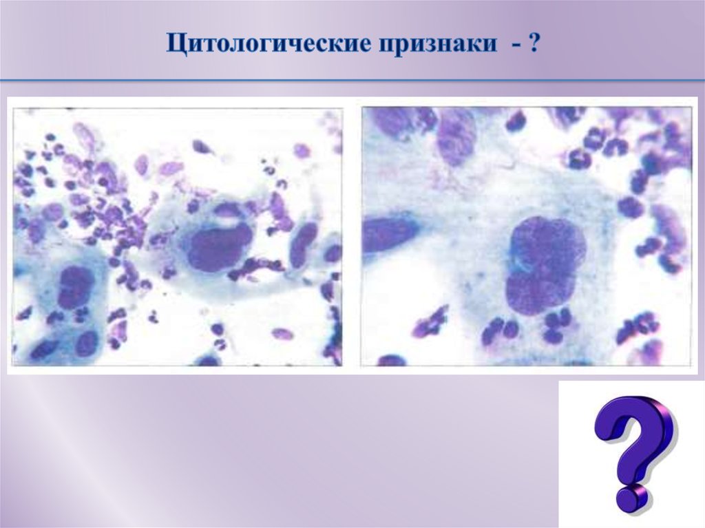 Цин 3. Цитологическое проявление. Цитологические критерии злокачественности. Дисплазия 3 цитологическая картина. Дисплазия предстательной железы Cin-3.