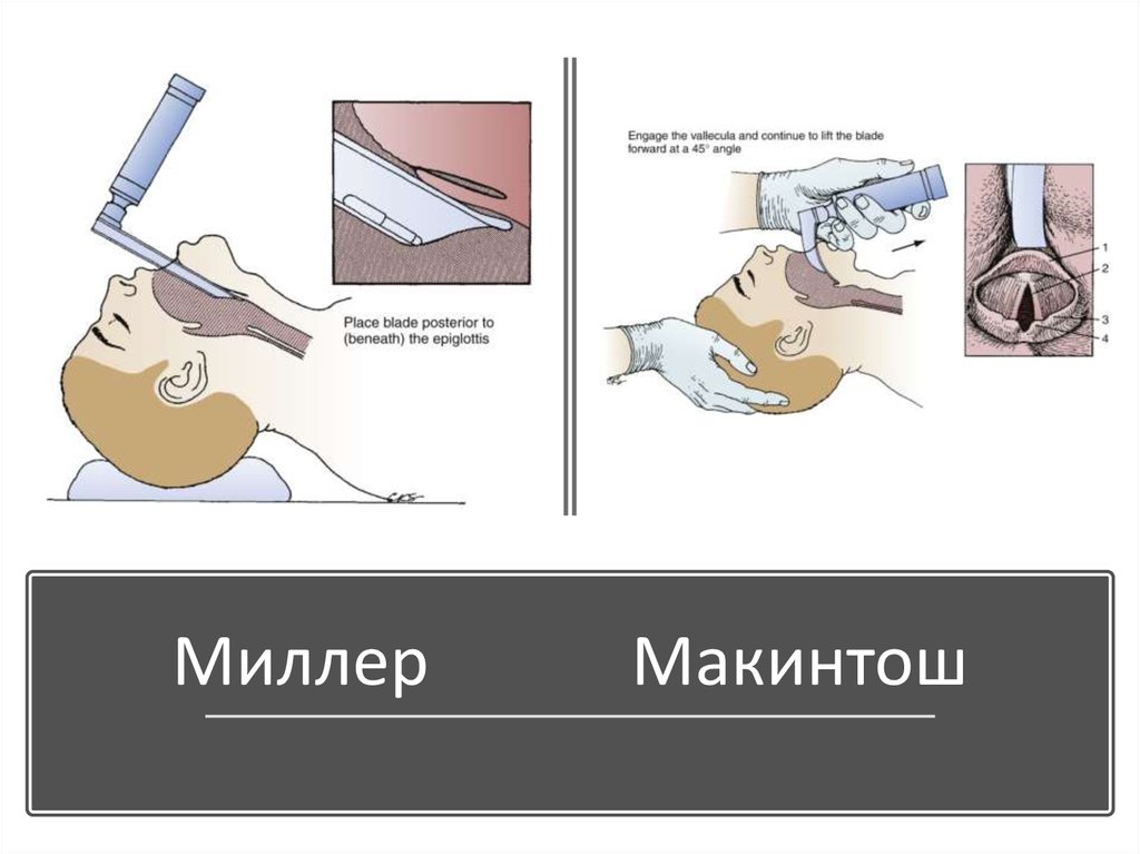 Как делать вентиляцию легких. Искусственная вентиляция лёгких. Искуственная вентиляция лёгких алгоритм. Алгоритм трудной интубации. Как сделать вентиляцию лёгких.