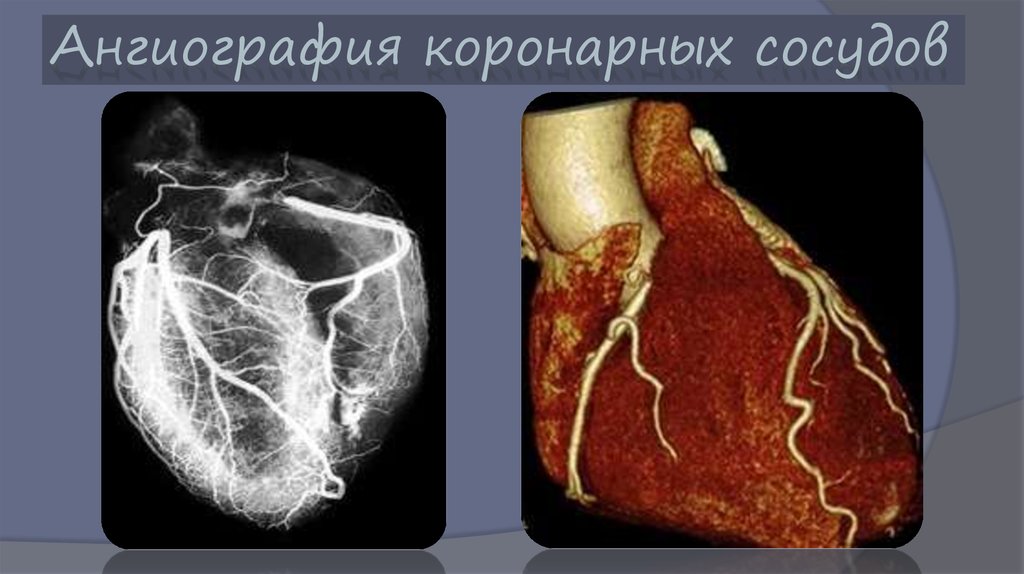 Исследование коронарного кальция. Ангиография коронарных сосудов. Кт-ангиография коронарных артерий. Ангиография коронарных артерий сердца. Мрт сердца и коронарных сосудов.