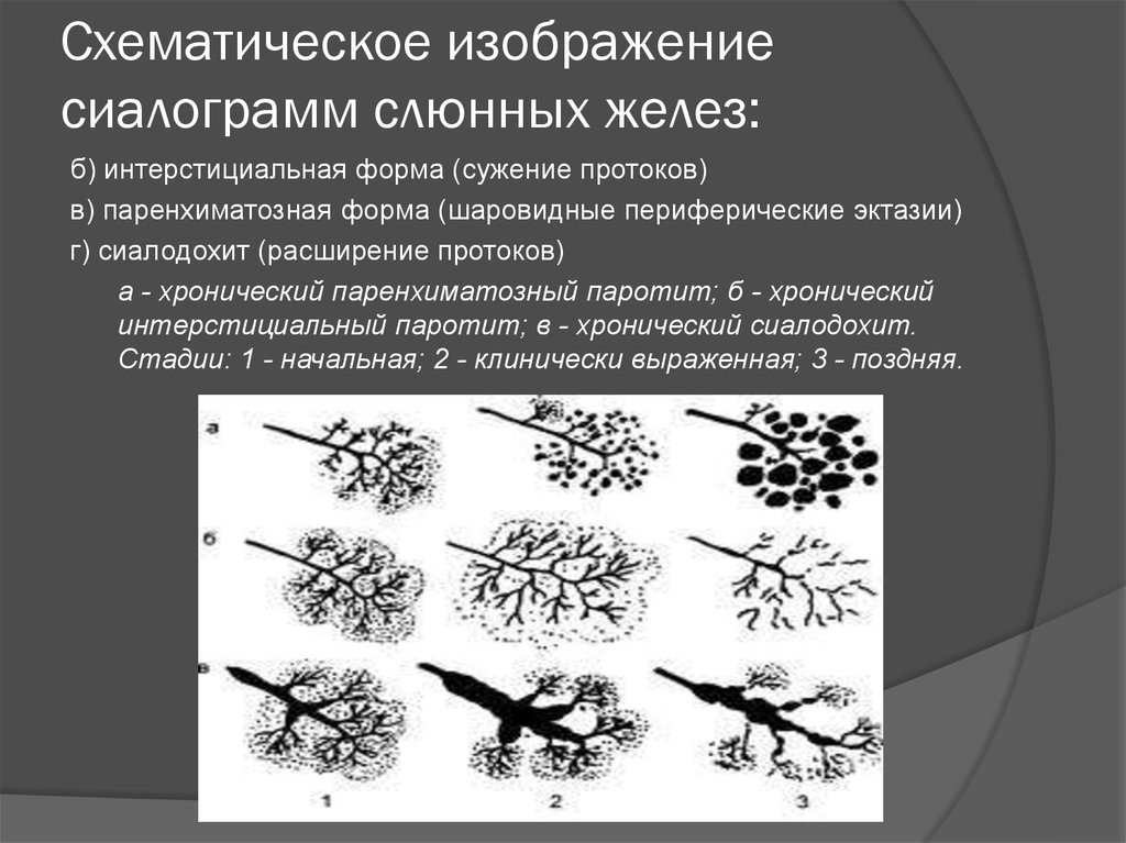 Воспалительные заболевания слюнных желез презентация