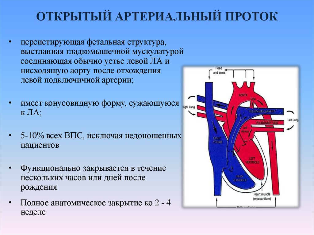 Оап у новорожденных. Врожденный порок сердца открытый артериальный проток. Открытый артериальный (боталлов) проток. Открытый артериальный (боталлов) проток (ОАП). ВПС: - открытый Баталов проток.