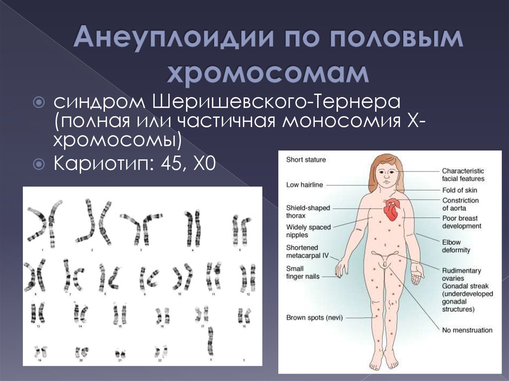 Анеуплоидии по половым хромосомам