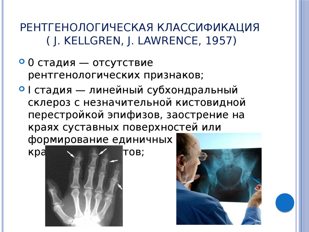 Склероз суставных поверхностей. Рентгенологическая классификация. Келлгрен Лоуренс. Kellgren классификация. Рентгенологическая стадия (Kellgren и Lawrence, 1957):.