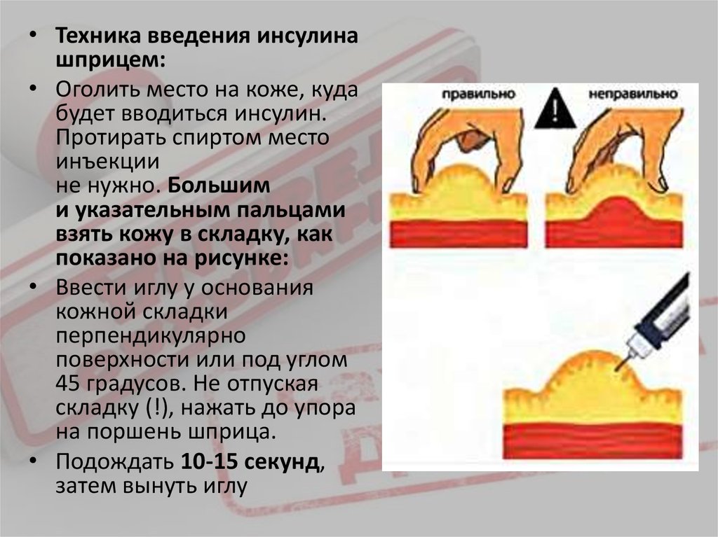 Инъекции инсулина кожа. Введение инсулина подкожно алгоритм. Продемонстрируйте технику введения инсулина. Техника выполнения инъекции инсулина. Продемонстрируйте технику подкожного введения инсулина..