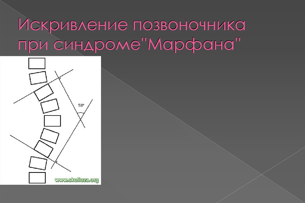 Искривление позвоночника при синдроме''Марфана''