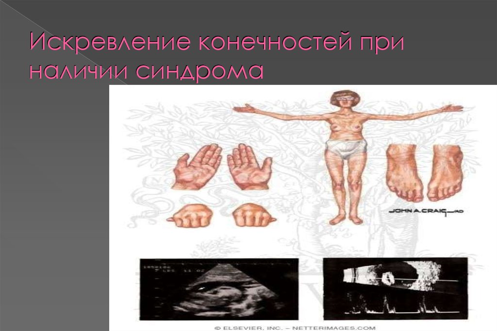 Искревление конечностей при наличии синдрома