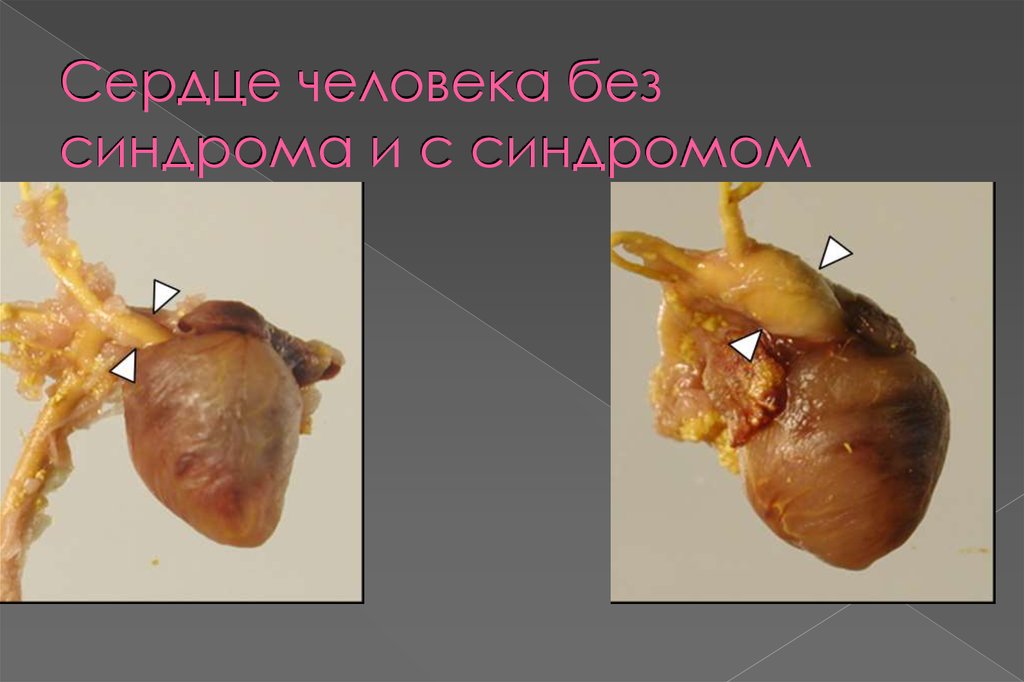 Сердце человека без синдрома и с синдромом