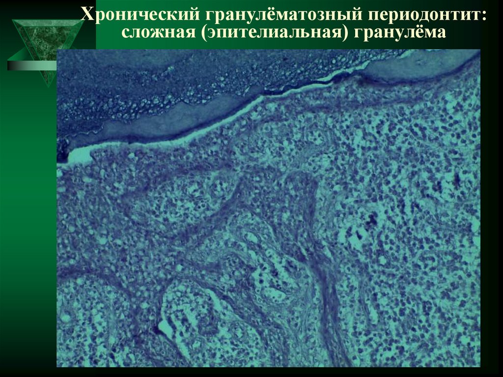 Этиология и патогенез апикального периодонтита презентация