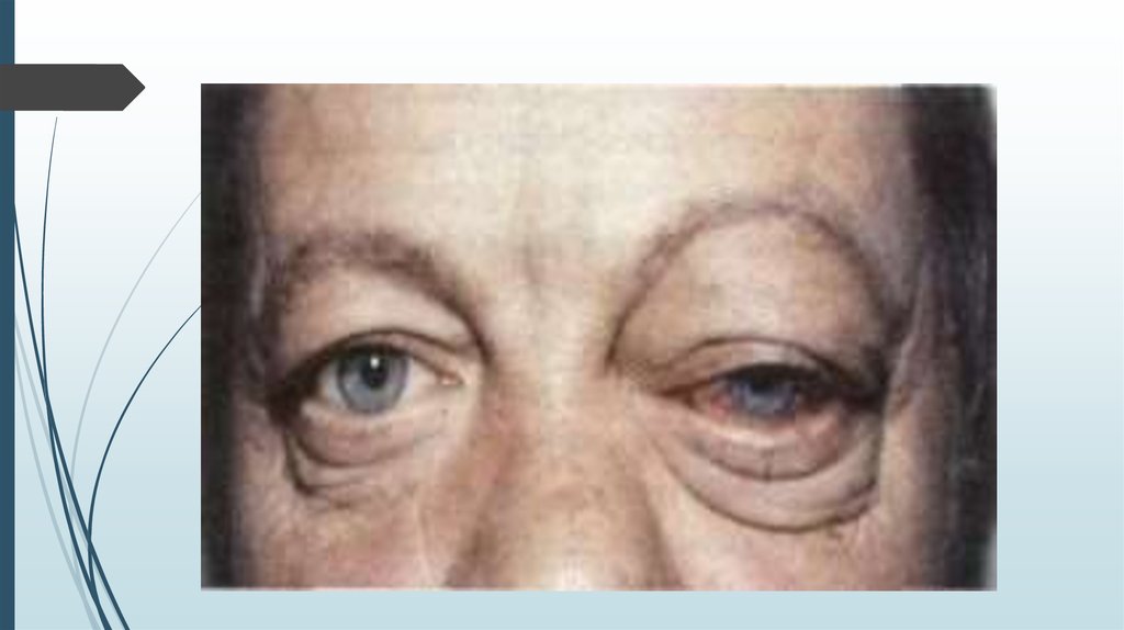 Тромбоз лицевой вены фото