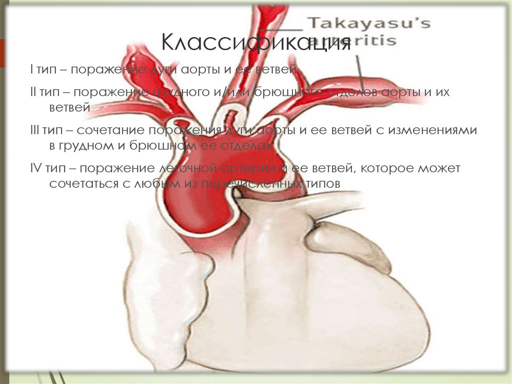 Дуга аорты у птиц. Синдром поражения дуги аорты.