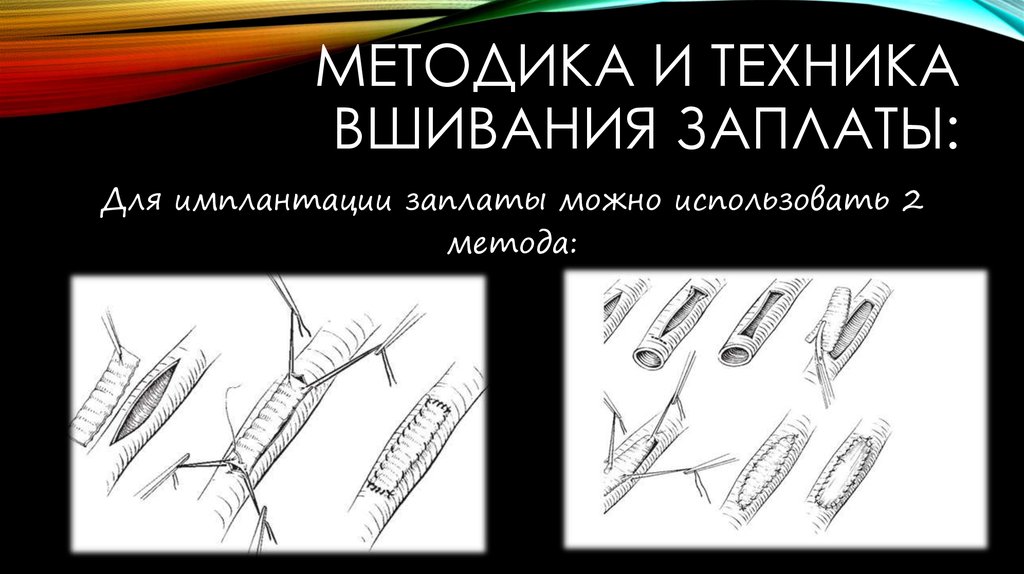 Методика и техника вшивания заплаты: