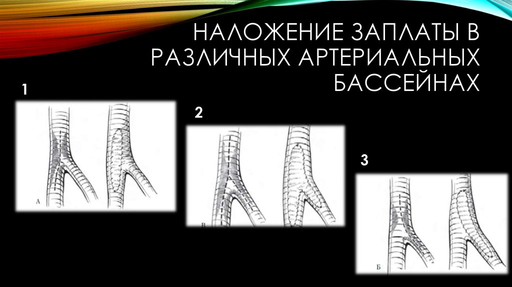 Наложение заплаты в различных артериальных бассейнах