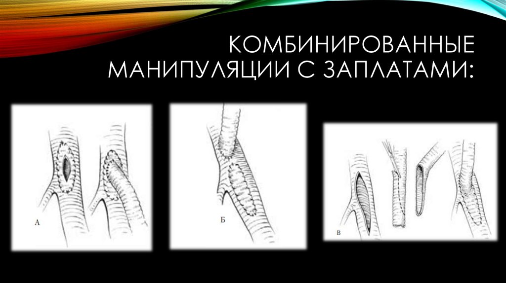 Комбинированные манипуляции с заплатами: