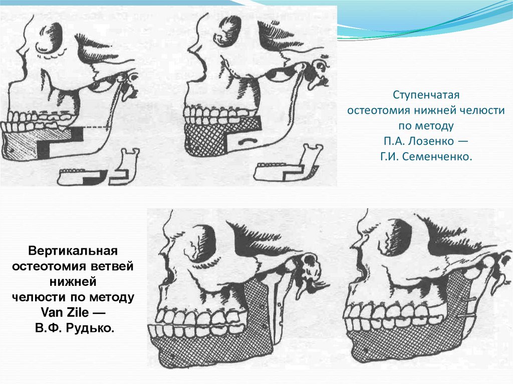 Остеотомия нижней челюсти