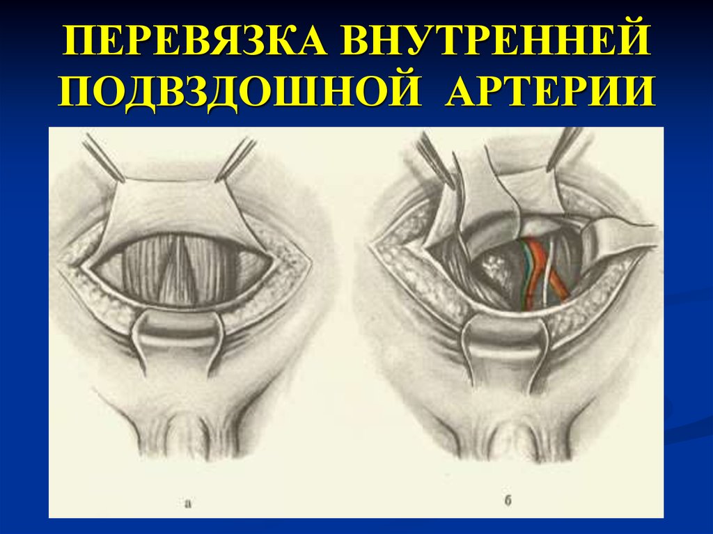 Перевязка маточных сосудов. Перевязка внутренних подвздошных артерий Акушерство. Перевязка внутренней подвздошной артерии техника. Лигирование внутренних подвздошных артерий.