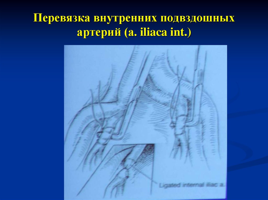 Перевязка маточных сосудов. Лигирование внутренних подвздошных артерий. Перевязка подвздошных артерий Акушерство. Перевязка внутренней подвздошной артерии. Перевязка наружной подвздошной артерии.