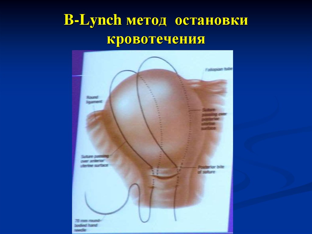 B метод. Компрессионный шов по б-Линчу. Компрессионные швы по b-Lynch. Компрессионные швы по Линчу.