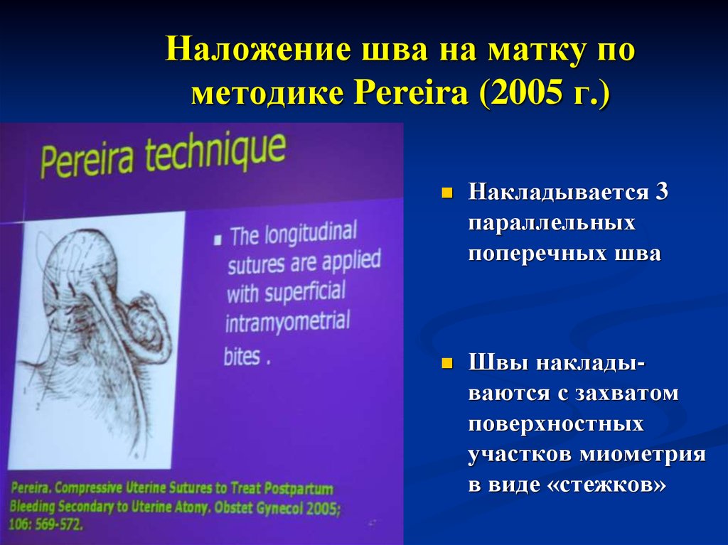 Наложение шва латынь. Компрессионные швы на матку. Компрессионные швы на матку по Перейра. Гемостатические швы на матку. Гемостатические швы на матку по Перейра.