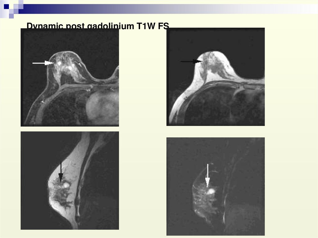 Лучевая диагностика заболеваний молочных желез презентация